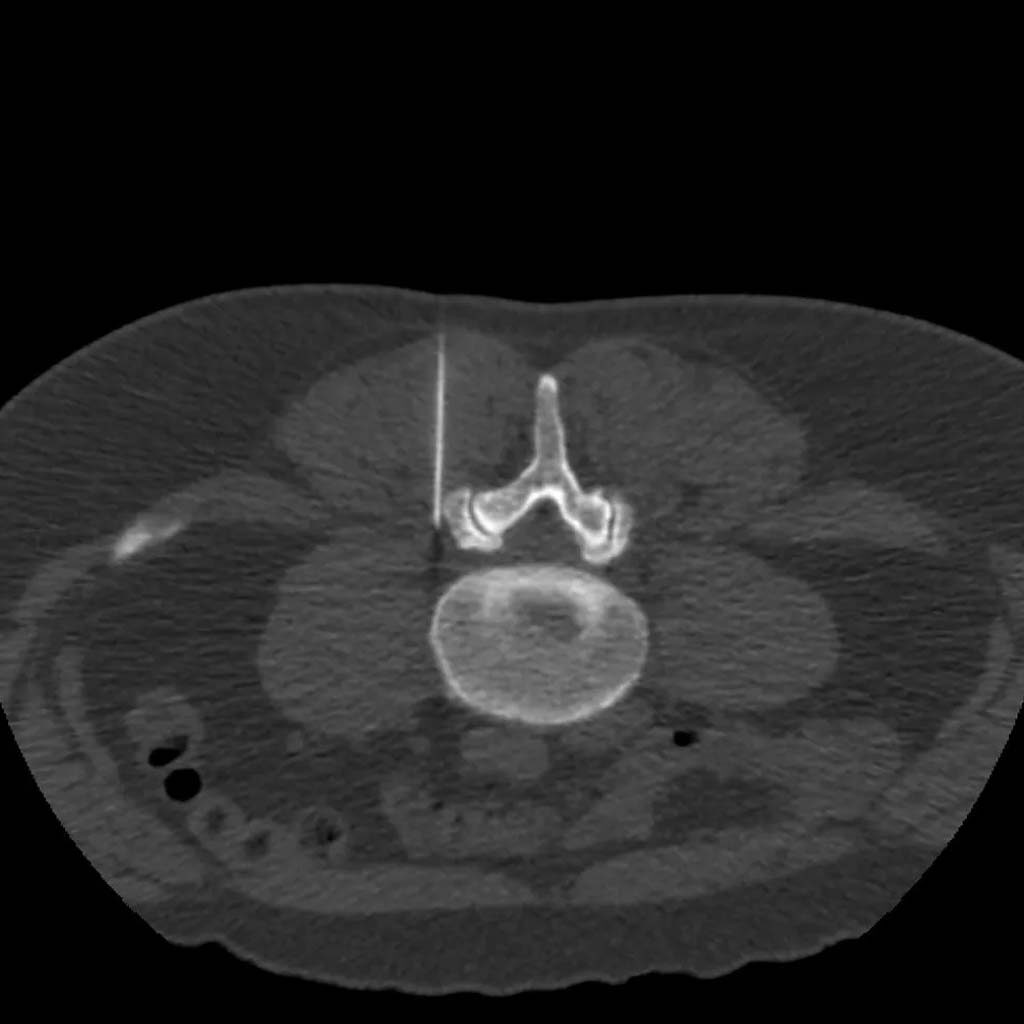 CT-Intervention