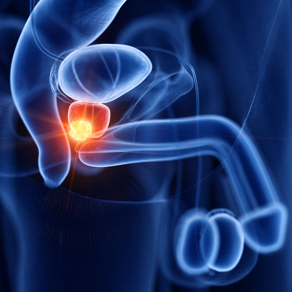 Active Surveillance Prostata